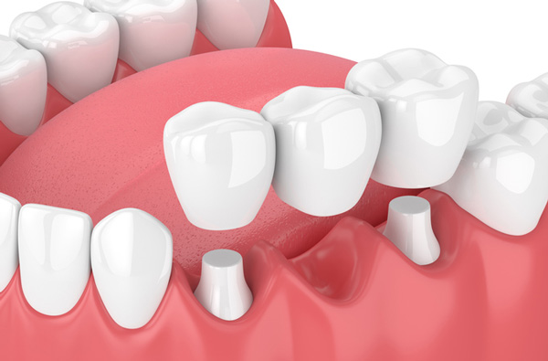 Rendering of jaw with dental bridge